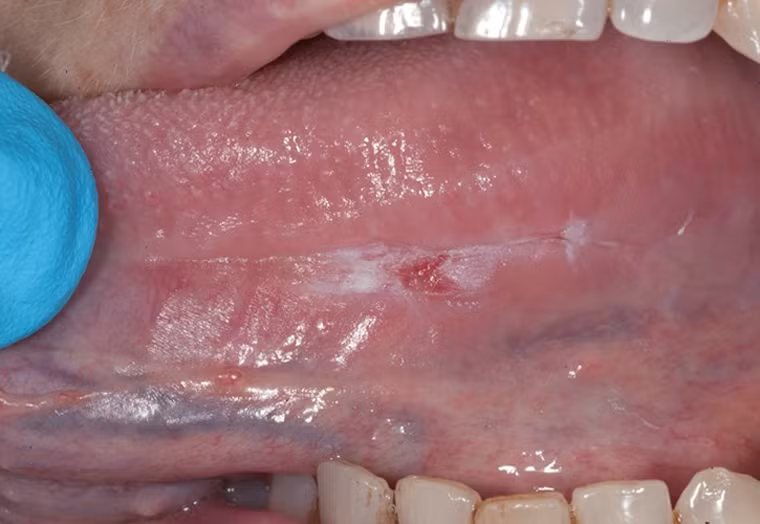 Ung thư lưỡi bắt nguồn từ sự phát triển bất thường của các tế bào vảy lót trong khu vực. Theo thời gian, những tế bào này hình thành nên khối u có khả năng phát triển mạnh mẽ, di căn đến các bộ phận xung quanh.