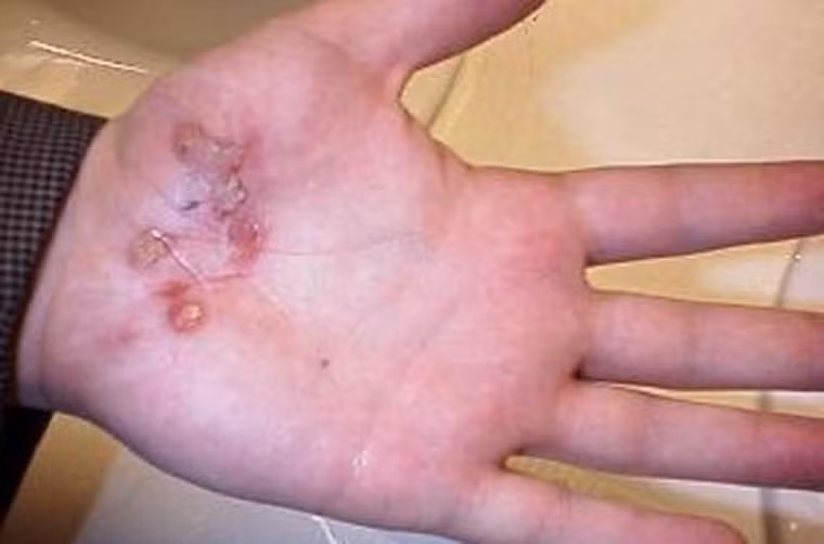 Nếu thấy cảm giác đau tại vết thương đang hoặc đã cải thiện qua 24 - 36 giờ nhưng sau đó đột ngột đau trở lại và có dấu hiệu da đỏ, sưng nề, cảm giác nóng khi chạm vào vết thương; trong người có các triệu chứng như sốt và gai rét, buồn nôn và nôn, tiêu chảy phải đến ngay cơ sở y tế để được điều trị kịp thời.