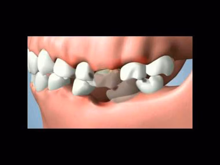 Xương hàm không đồng đều. Nguyên nhân chính của tình trạng xương hàm không đồng đều là do sự cố sâu răng, buộc phải nhổ bỏ mà không có răng thay thế. Từ đó, tạo ra một khoảng trống, khiến những chiếc răng khác có xu hướng ngả dần về vị trí này để lấp đầy.