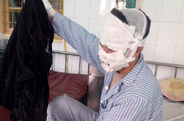 Cũng liên quan đến bóng bay, ngày 16/1/2014, gia đình anh Phan Minh Đức (Long Biên, Hà Nội) dự đám cưới của người thân tại nhà hàng. Khi về, các con anh cầm một chùm bóng trang trí tại buổi tiệc. Thấy lũ trẻ đòi chia, anh Đức dùng bật lửa đốt đoạn dây buộc thắt nút, khiến cả chùm bóng gần 30 quả bất ngờ phát nổ. Tiếng nổ lớn đến mức người nhà tưởng nổ bình gas. Hậu quả là 3 bố con anh Đức và 1 người cháu bị bỏng ở mặt, cổ, tai, hai bàn tay phải nhập viện Saint Paul.