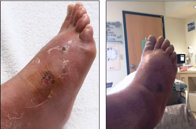 Vi khuẩn “ăn thịt người” chủ yếu tấn công cơ thể người thông qua các vết thương như từ vết đốt của côn trùng, bỏng hoặc vết cắt trên da gây nhiễm trùng. Đặc biệt, những các đối tượng thường xuyên tiếp xúc với nước bẩn như công nhân vệ sinh, cống rãnh, người nuôi tôm cá… dễ có nguy cơ bị vi khuẩn tấn công.