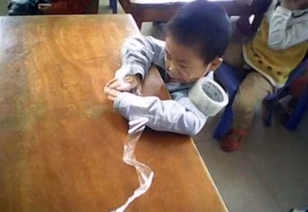  3. Băng dính: Ngày 30/11/2007, bảo mẫu Lê Thị Lê Vy (SN 1977, tại Bình Thuận) tiếp nhận cháu Đỗ Ngọc Bảo Trân. Bé Trân còn nhỏ nên khi thấy mẹ đi ra ngoài thì cháu khóc, la hét. Vy dỗ mãi không được nên đến hộc tủ lấy cuộn băng dính cắt một đoạn dài khoảng 5cm rồi dán ngang miệng bé. Khoảng 5 - 6 phút sau, một cô giáo khác phát hiện cháu Trân nằm úp mặt xuống gối, nên gọi Vy đến kiểm tra thì đứa trẻ đã trong tình trạng mặt mũi tím tái. Đến ngày 28/12/2007, cháu tử vong tại Bệnh viện Nhi đồng 1. Trong ảnh là trường hợp 1 trẻ bị bạo hành bằng việc dán băng dính vào mũi, miệng tại Trung Quốc.