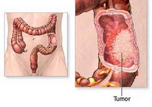 Bạn có biết ăn quá nhiều thịt trong bữa trưa sẽ làm tăng nguy cơ ung thư đại tràng.