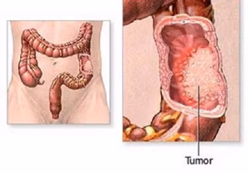 Bạn có biết ăn quá nhiều thịt trong bữa trưa sẽ làm tăng nguy cơ ung thư đại tràng.