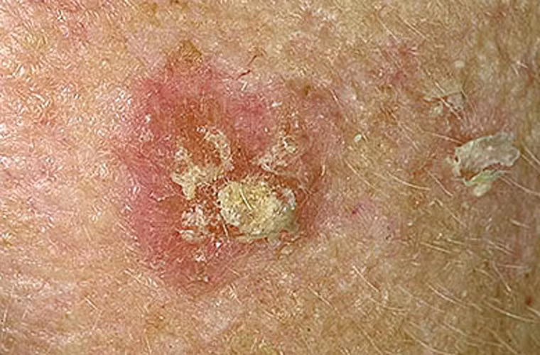 Báo cáo thống kê hàng năm của Hiệp hội Ung thư Canada cho thấy tỷ lệ ung thư da trong hai thập kỷ qua đã tăng lên, đặc biệt là trong số những người trên 50 tuổi. Tuy nhiên, một điều đáng lưu ý khác đang có sự trẻ hóa về đối tượng mắc bệnh.