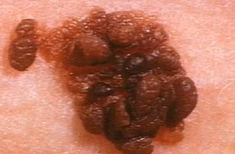 Đặc biệt, nếu bị cháy nắng dẫn đến phồng rộp trước tuổi 20 có thể làm tăng gấp đôi nguy cơ phát triển các khối u ác tính. Nghiên cứu cũng cho thấy đối tượng sử dụng giường tắm nắng trong nhà trước tuổi 65 cũng đối diện với nguy cơ căn bệnh tấn công cao hơn nhiều.