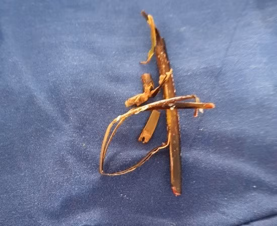 Lay canh cay kho dai 10cm trong bang quang benh nhan nam-Hinh-2