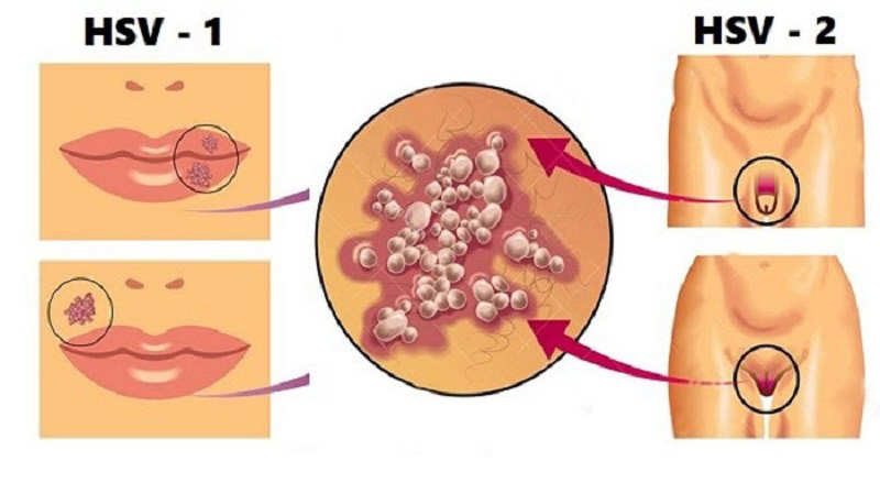 5 dieu nen biet khi bi mun rop sinh duc