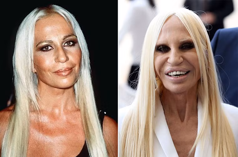 Còn khi so sánh hình ảnh Donatella năm 1998 (trái) và bây giờ, ai nhìn thấy cũng phải choáng.