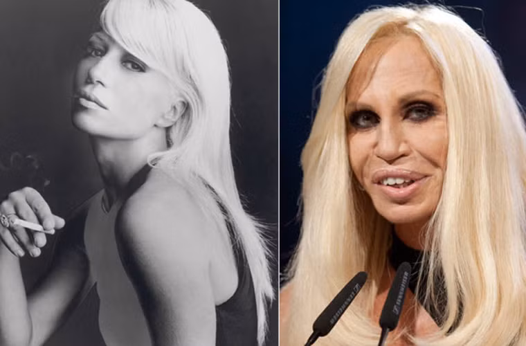 Thời trẻ, Donatella Versace từng là một giai nhân tuyệt sắc. Thế nhưng thói nghiện phẫu thuật thẩm mỹ và việc không chấp nhận bị già đi theo thời gian đã khiến Donatella biến dạng thế này.