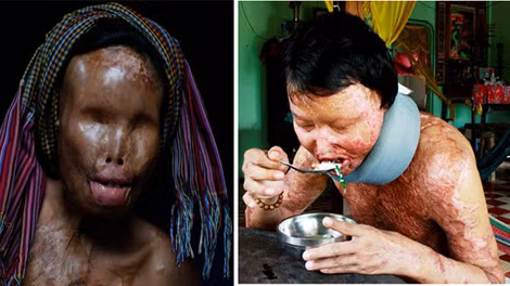 Trong tháng 6 và những ngày đầu tháng 7/2013, hàng loạt những vụ án liên quan đến axít xảy ra khiến dư luận bàng hoàng.