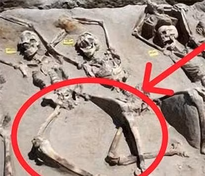 Ly do chan cua phi tan chon trong mo co bi tach ra