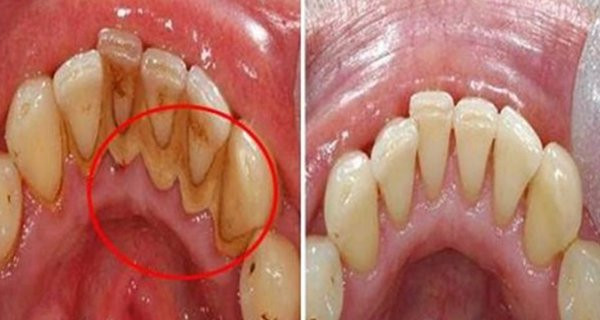 Cao răng bật ra từng mảng lớn chỉ với thứ rẻ tiền này Cao rang bat ra tung mang lon chi voi thu re tien nay