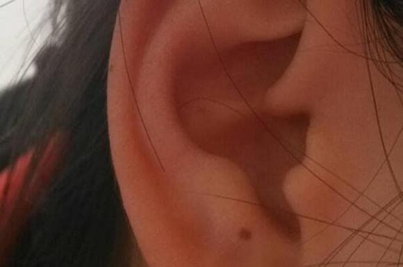 Tuy nhiên, bạn nên chú ý một điều rằng nếu có nốt ruồi ở dưới dái tai thì bạn nên cẩn thận với một số bệnh mãn tính, nếu không có thể ảnh hưởng đến sức khỏe.