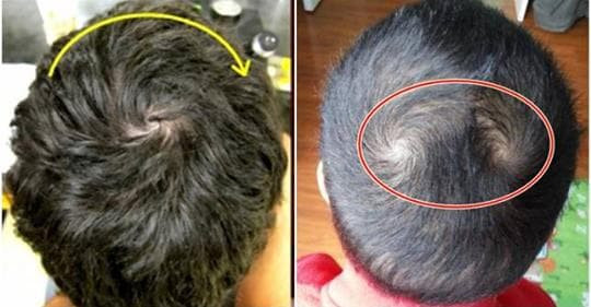 Xoay toc tren dau co the tiet lo van menh giau ngheo, tri tue cao thap-Hinh-2