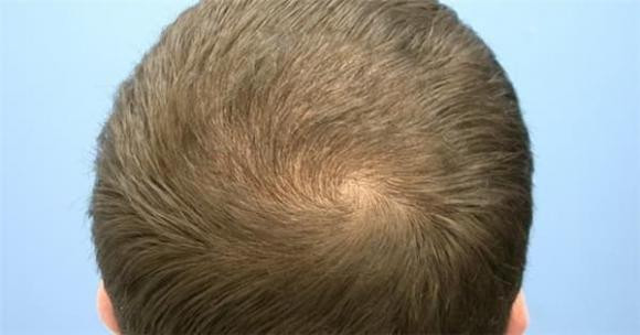 Xoay toc tren dau co the tiet lo van menh giau ngheo, tri tue cao thap