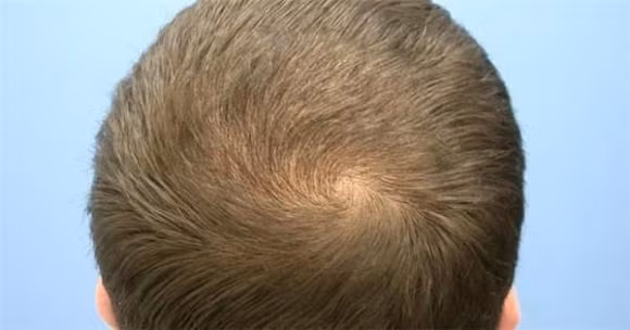 Xoay toc tren dau co the tiet lo van menh giau ngheo, tri tue cao thap