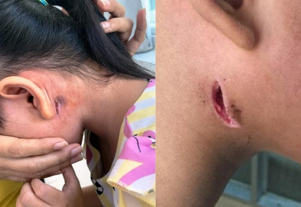 Benh nhi 15 tuoi tu vong vi nhiem Whitmore, Bo Y te ra khuyen cao