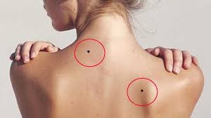 Vi tri not ruoi so kho, buoc ra cua la gap thi phi