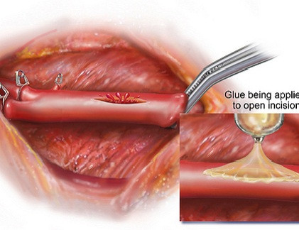 Keo kết dính có tác dụng hàn gắn vết thương, lỗ hổng ở tim.