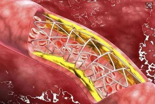 Mo mau co cao hay khong, nhin bap chan