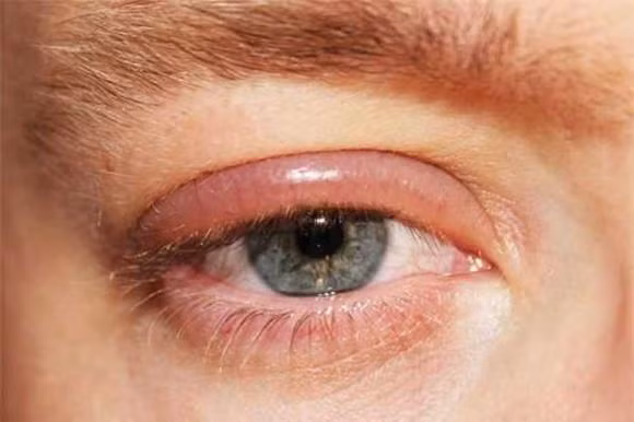 Trong nguoi co ung thu, doi mat la 'tien tri'-Hinh-2