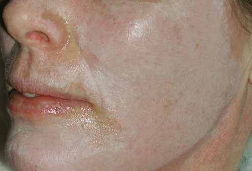 Mặt nạ hóa chất: Liệu pháp này là dùng một lượng dung dịch a xít để tẩy tế bào chết trên da, dung dịch này gồm: axit glycolic, axit lactic, axit salicylic, axit phenol hoặc tricloaxetic (TCA). Liệu trình điều trị mất ít nhất 15 phút và có thể gây kích ứng da. Sau vài ngày, lớp da trên cùng sẽ bị lột, da mới trở nên trẻ trung và mượt mà hơn.