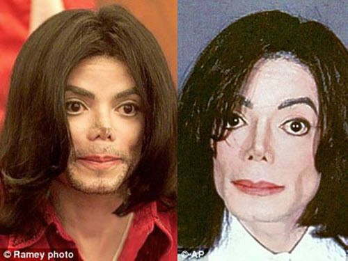 Rất nhiều người sau khi phẫu thuật, mũi đã bị biến dạng. Ví dụ điển hình nhất là ông hoàng nhạc Pop - Michael Jackson. Chỉnh sửa mũi quá nhiều lần, bác sĩ lại thực hiện quá tay khiến các mô mũi bị xô lệch nghiêm trọng, cấu trúc da mũi bị xơ cứng lại, vết thương lâu lành và khiến mũi bị biến dạng, xơ cứng.