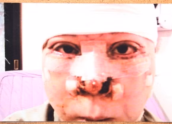 Phần thịt bên cánh mũi bị cắt đi toàn bộ khiến máu đông tụ lại.