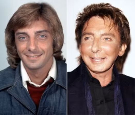 Barry Manilow là một ngôi sao nhạc rock từng nổi tiếng một thời. Barry Manilow liên tục cán đích với thứ hạng cao tại các bảng xếp hạng uy tín. Barry Manilow thừa nhận đã tiến hành phẫu thật thẩm mỹ nhiều lần với việc bơm botox, căng da…Tuy nhiên, kết quả dường như không được như mong muốn, chiếc mũi mới quá dài thành ra bị khoằm, gồ cao, lộ sóng nâng.