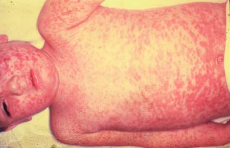 Khi phát hiện có trẻ mắc sởi, điều quan trọng cần chú ý là thực hiện việc cách ly trẻ bệnh với các trẻ lành. Người chăm sóc trẻ bệnh phải rửa tay sạch sẽ trước và sau mỗi lần tiếp xúc với trẻ bệnh, rồi mới được chăm sóc trẻ lành.