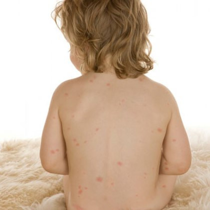 Tiêu chảy: Hay gặp, có thể gây mất nước cấp ở trẻ em.