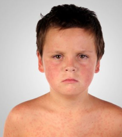 Loét giác mạc mắt: Do thiếu vitamin A. Có thể dẫn đến thành lập hạt Bitol và mù.