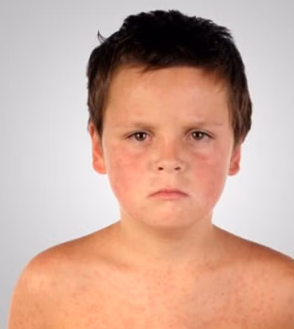 Loét giác mạc mắt: Do thiếu vitamin A. Có thể dẫn đến thành lập hạt Bitol và mù.