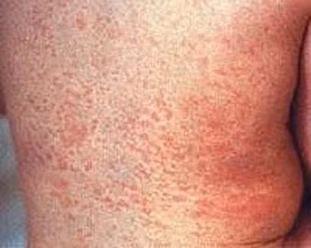 Ban xuất hiện khoảng 5-6 ngày và khi “tàn” sẽ có màu hơi nâu nâu rồi sẽ biến mất, để lại lớp da khô, bong tróc.