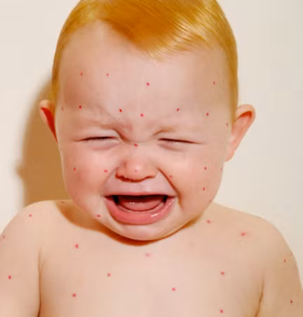 Mắt đỏ và nhạy cảm với ánh sáng mặt trời