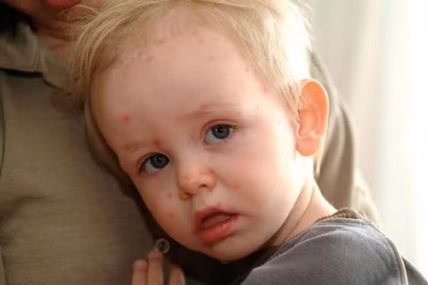 Mệt mỏi. Ngoài ra là cảm thấy ốm mệt, có cảm giác đau nhức; chứng ho trở nên nặng hơn.