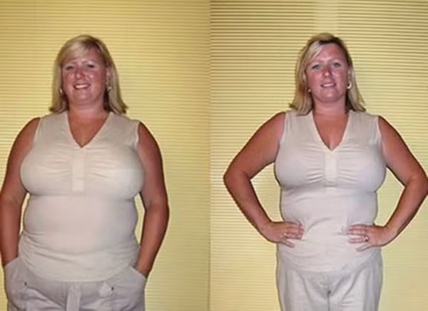 Lợi ích của phẫu thuật dạ dày giảm cân. Giảm cân nhanh: Một ca phẫu thuật dạ dày giảm cân có thể giúp giảm đến 60% trọng lượng cơ thể bạn. Cho nên, với phương pháp này bạn sẽ giảm cân nhanh hơn các phương pháp khác.