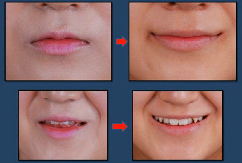 Phẫu thuật thẩm mỹ môi cười. Phẫu thuật môi cười là phẫu thuật tạo hình khóe miệng 2 bên tạo thành miệng hình cung với mặt lõm hình cung quay lên trên làm cho khuôn miệng tươi hơn. Sau khi thực hiện thủ thuật thẩm mỹ này, khuôn mặt và nụ cười dường như sẽ thay đổi đáng kể.