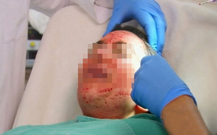 Sau li tâm, phần huyết tương tiểu cầu (phần ở giữa) sẽ được tiêm vào da. Ảnh T.G