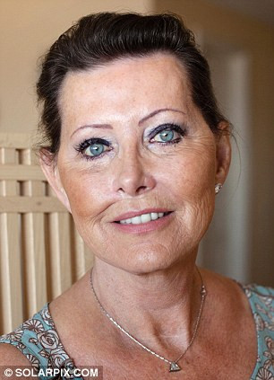 Bà Jackie đã phải nhờ đến bác sĩ thẩm mĩ Kevin Hancock để căng da mặt. Ông Hancock bắt đầu bằng cách giải phóng các mô sẹo từ phẫu thuật. Sau đó 150ml chất béo được hút từ bụng Jackie, và ly tâm để loại bỏ máu và dầu. 50ml chất béo sau lọc được tiêm vào má để cân bằng khuôn mặt của bà.