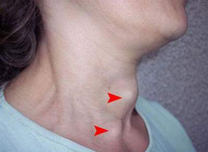 Ung thư nhú chủ yếu ảnh hưởng đến phụ nữ trong nhóm tuổi 30 - 40. Đây là loại ung thư có thể được chữa khỏi nếu được chẩn đoán sớm.