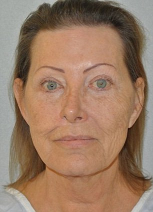 Sau ca phẫu thuật 6 tiếng tại Bệnh viện Winterbourne ở Dorset để loại bỏ ung thư, bác sĩ đã phát hiện dấu hiệu di căn trên các cơ và chất béo trong má, bên cạnh mũi, nguy hiểm hơn là góc bên ngoài của mắt phải.