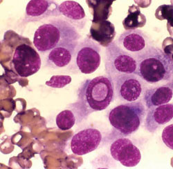 1. Ung thư thể nhú: Các khối u nhú được hình thành trong các tế bào sản xuất triiodothyronine hoặc T3 (hooc môn tuyến giáp có chứa iốt). Đây là loại ung thư phát triển chậm, xuất hiện rất nhiều khối u nhỏ có hình dạng như nấm.