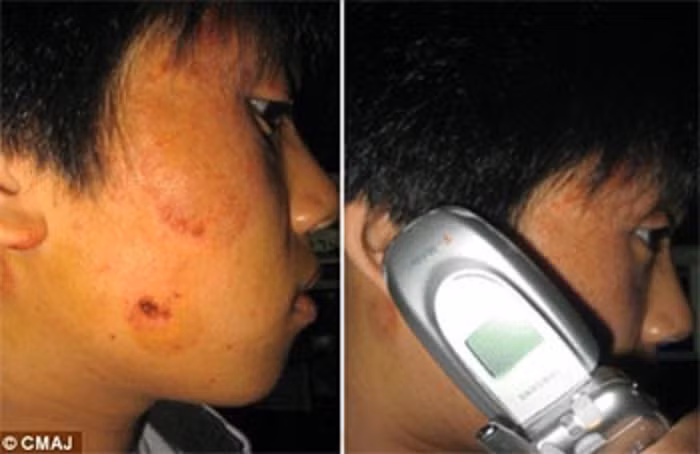 Dị ứng da: Một nghiên cứu gần đây đã chứng minh rằng niken và crom trong vỏ bọc điện thoại di động có thể gây ra phản ứng trên da được gọi là viêm da tiếp xúc dị ứng. Vì vậy, nếu bạn có làn da nhạy cảm, hãy sử dụng miếng dán hoặc bỏ bọc nhựa để hạn chế sự tiếp xúc của da với các thành phần gây dị ứng.