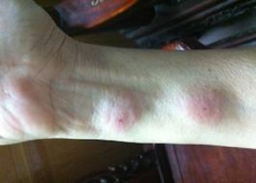 Ngoài ra bọ xít còn thải ra phân có chứa T.cruzi nạn nhân gãi vào vết chích sẽ làm T.cruzi theo máu hoặc chất nhầy xâm nhập vào cơ thể. T.cruzi có thể “ngủ yên” từ 10 đến 20 năm, sau đó sẽ gây một số vấn đề mạn tính về tim mạch, hệ tiêu hóa và hệ thần kinh.