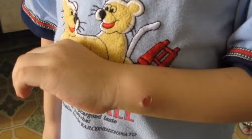 Căn bệnh này là một mối họa cho sức khỏe cộng đồng ở khu vực Trung-Nam Mỹ. Tổ chức Y tế Thế giới cho biết, trong số 360 triệu người sống ở những “điểm nóng” của bệnh Chagas, khoảng 90 triệu người có nguy cơ mắc bệnh và gần 10 triệu người đã nhiễm bệnh. Hằng năm có từ 30.000 đến 50.000 người chết vì bệnh Chagas.