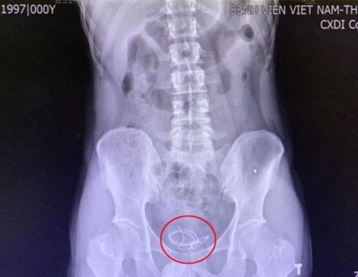 Nghich dai vi muon tao khoai cam, nam thanh nien phai nhap vien