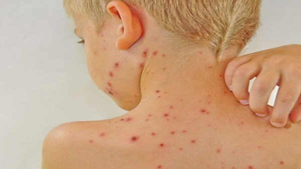 4. Da bị phát ban và ngứa ngáy: Khi thận gặp vấn đề sẽ gây ảnh hưởng đến quá trình lọc chất thải ở trong máu. Điều này khiến cho da bị phát ban và ngứa ngáy. Chính vì vậy, cần phải lưu ý khi gặp những triệu chứng ở da như thế này. Ảnh minh họa