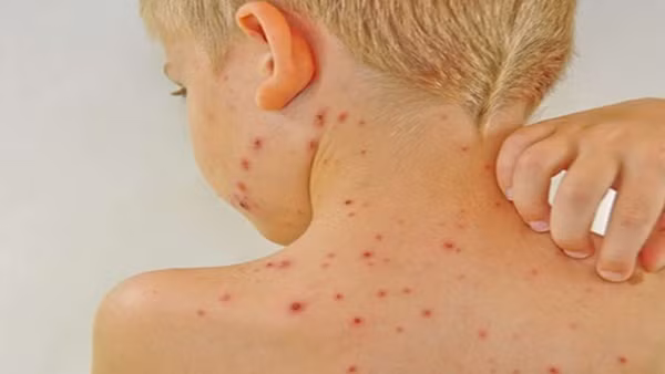 4. Da bị phát ban và ngứa ngáy: Khi thận gặp vấn đề sẽ gây ảnh hưởng đến quá trình lọc chất thải ở trong máu. Điều này khiến cho da bị phát ban và ngứa ngáy. Chính vì vậy, cần phải lưu ý khi gặp những triệu chứng ở da như thế này. Ảnh minh họa